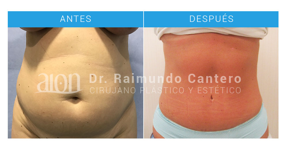 abdominoplastia precios malaga