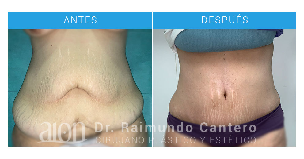 abdominoplastia en malaga
