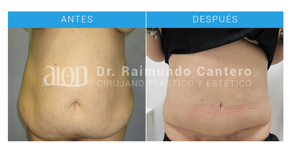cirugia abdomen malaga