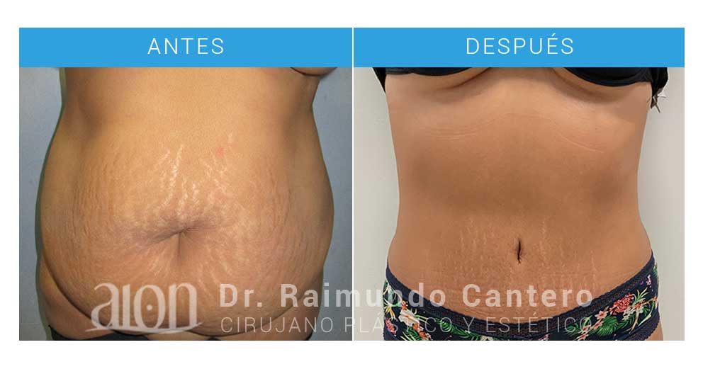 abdominoplastia malaga