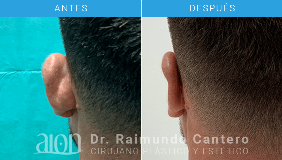 otoplastia precio en malaga