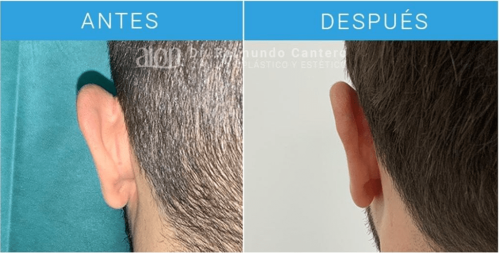 cirujano plastico malaga otoplastia